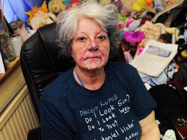 Phi thường - kỳ quặc - Người phụ nữ bị mặt trời "ăn" da thịt