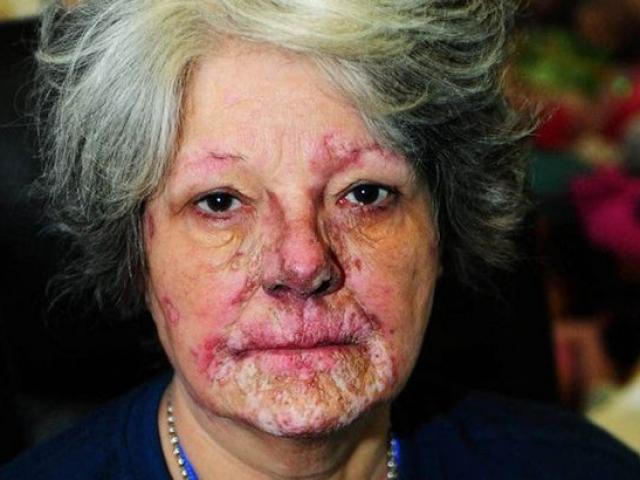 Người phụ nữ 15 năm sống chung với bệnh "mặt trời ăn da thịt"