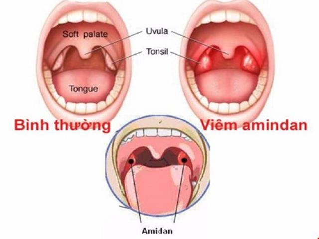 Viêm amidan, khi nào nên cắt?