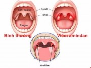 Sức khỏe đời sống - Viêm amidan, khi nào nên cắt?