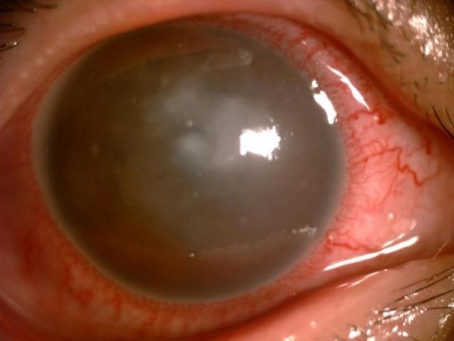 Sức khỏe đời sống - Không muốn ký sinh trùng ăn mòn giác mạc, cần bỏ kính này