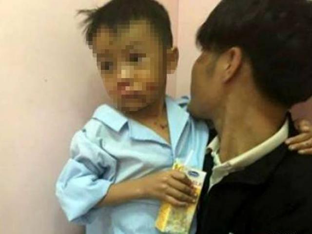 Tin tức trong ngày - Nghịch đồ lạ, 2 anh em bị dập nát tay, chấn thương mặt