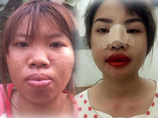 Thẩm mỹ viện - "Thị Nở tái sinh" gây sốc chi tiền núi để "xây lại mặt"