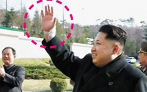 Tin tức trong ngày - Rộ tin ông Kim Jong-un bị chấn thương cổ tay