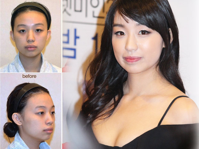 Thẩm mỹ viện - Cô gái răng hô, môi dày hóa hot girl nhờ thẩm mỹ