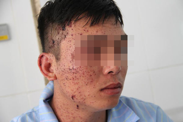 Tin tức trong ngày - 5 người thương vong vì mìn: Muốn giết con cháu, bố kích nổ tự sát?