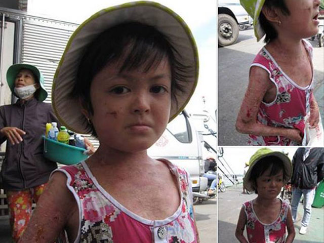 Tin tức trong ngày - Thực hư vụ cháu bé bị đổ nước sôi vào người để ăn xin