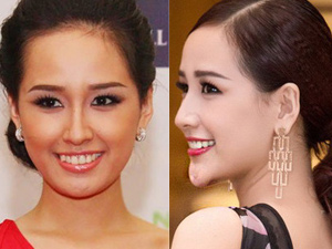 Thẩm mỹ viện - Hoài nghi trước cằm dài, nhọn bất thường của người đẹp Việt
