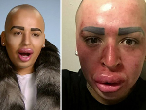 Thẩm mỹ viện - Bản sao Kim "siêu vòng 3" gặp họa sau 50 lần bơm môi