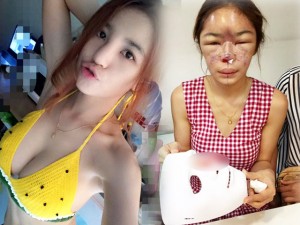 Thẩm mỹ viện - Hot girl Thái hóa “mặt quỷ” vì sự cố tiêm silicon