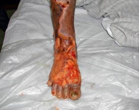 Căn bệnh khiến 20 giây có một người phải cắt chân