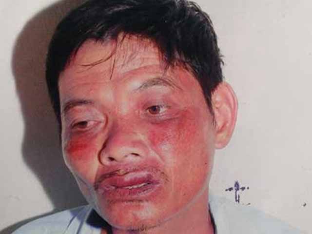 Pháp luật - Nhập viện sau khi đến công an xã ‘làm việc’?