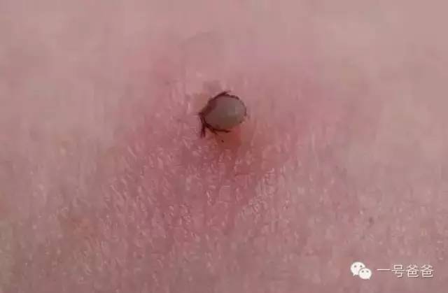 Sức khỏe đời sống - Kinh hãi con bọ ve "đào hầm" vào lưng bé trai 5 tuổi