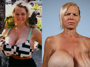 Thẩm mỹ viện - Vũ công khổ sở vì bộ ngực khổng lồ, "bên nổ bên xịt"