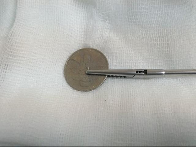 Sức khỏe đời sống - Hà Tĩnh: Cứu cháu bé 5 tuổi bị hóc đồng xu