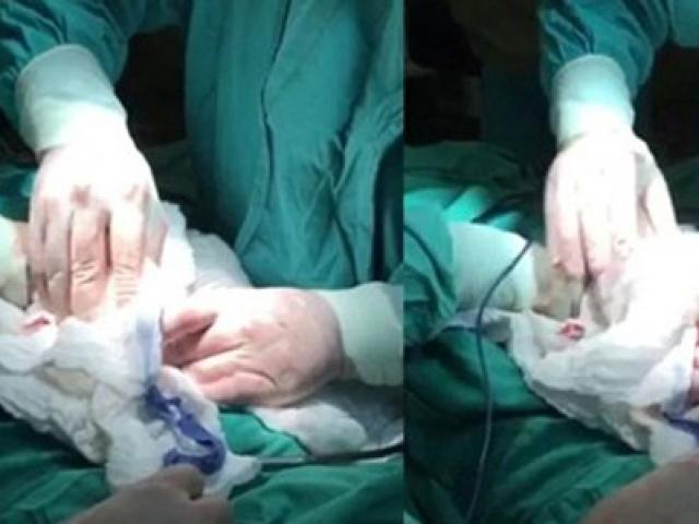 Phi thường - kỳ quặc - Củ sắn dài gần 50cm 'mắc kẹt' trong hậu môn người đàn ông