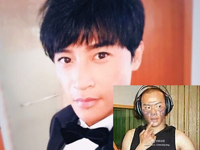 Đời sống Showbiz - Tài tử "Hoàn châu cách cách" chia sẻ ảnh mặt bị bỏng nặng