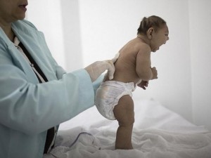 Sức khỏe đời sống - Khẳng định chắc chắn virus Zika gây ra chứng teo não