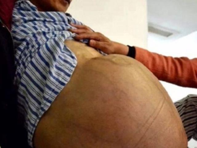 Sức khỏe đời sống - Người đàn ông "mang bầu" vì khối u khổng lồ