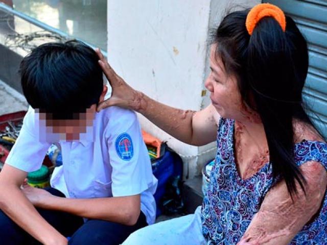 Tin tức trong ngày - Nỗi đau người mẹ bị tạt axit: Bỏ việc vì sợ con tự tử