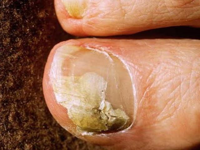 Sức khỏe đời sống - 6 mẹo dễ dàng giúp trị bệnh nấm móng