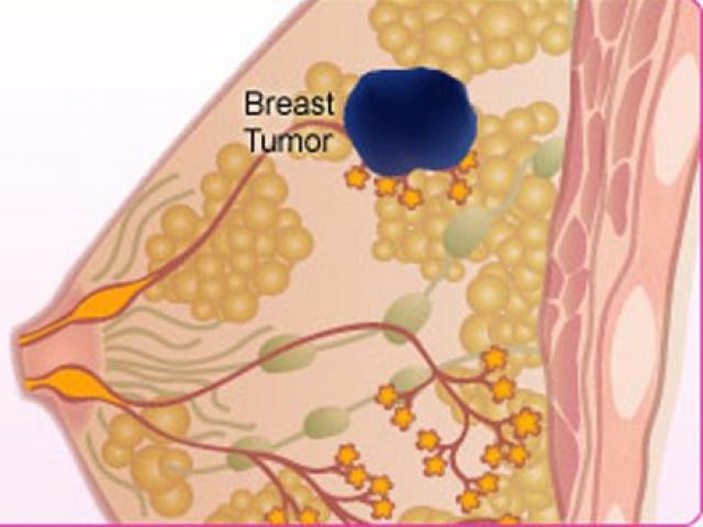 Sức khỏe đời sống - Bị ngứa đầu nhũ hoa, đi khám phát hiện bị ung thư vú