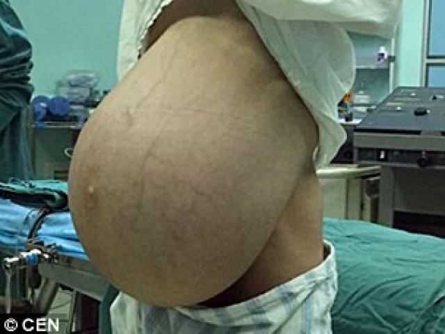 Sức khỏe đời sống - Kinh hoàng người đàn ông "mang thai" khối u 15kg suốt 10 năm