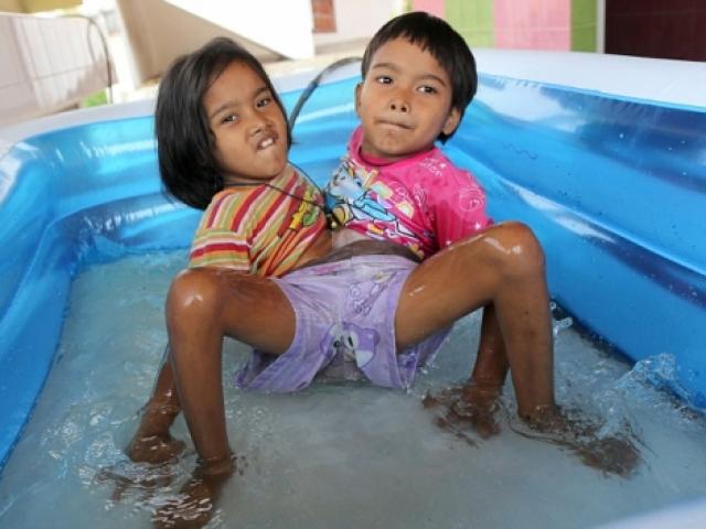 Sức khỏe đời sống - Cặp song sinh dính liền thân quyết không phẫu thuật vì muốn "sống cùng nhau"