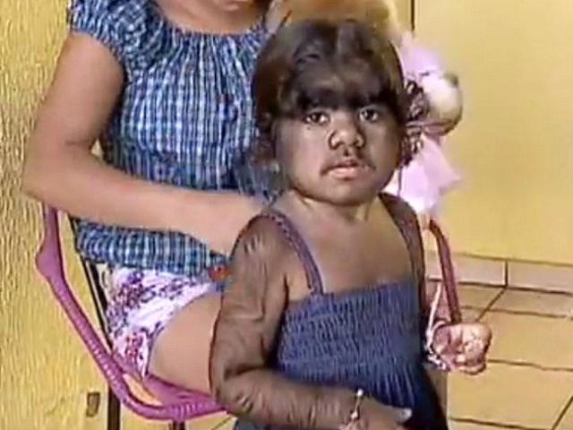 Phi thường - kỳ quặc - Bé gái mắc hội chứng “ma sói” đáng sợ