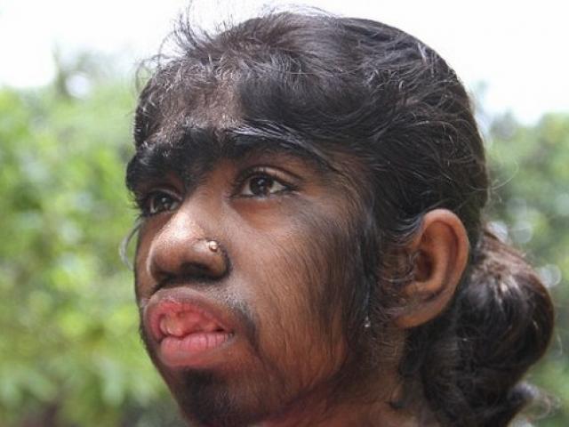 Thế giới - Bé gái “người sói” lông phủ kín toàn thân ở Bangladesh