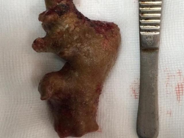 Sức khỏe đời sống - Lấy sỏi san hô to như củ gừng ở thận của bệnh nhân