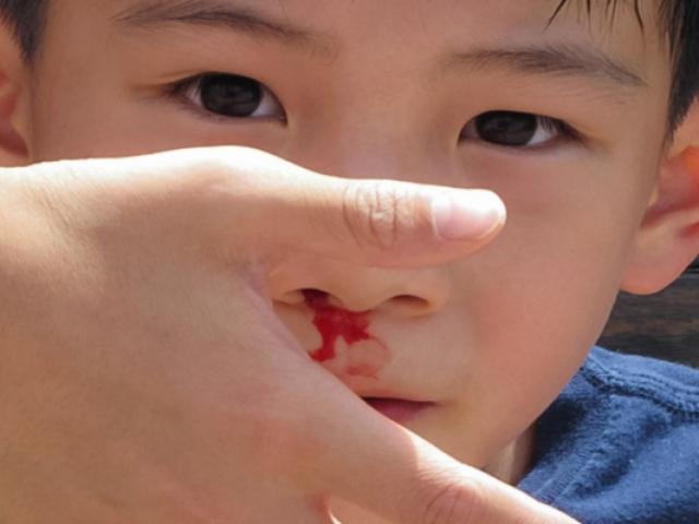 Khi nào nên cho trẻ bị chảy máu cam đến bác sĩ?
