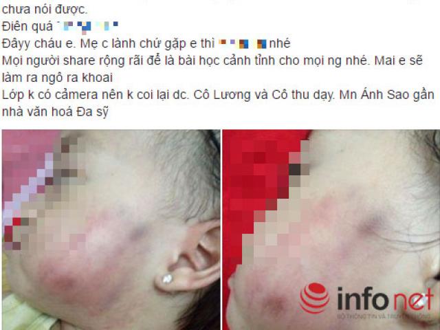 Tin tức trong ngày - Bé 17 tháng tuổi thâm tím mặt: Trần tình của cô giáo