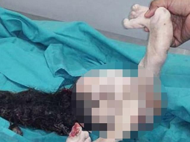 Phi thường - kỳ quặc - Cậu bé Malaysia "mang bầu" em ruột suốt 15 năm