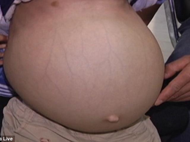 Phi thường - kỳ quặc - Cậu bé 6 tuổi "bụng chửa" ở Trung Quốc