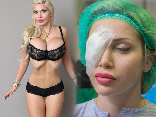 Thẩm mỹ viện - Người mẫu vừa cắt xương sườn lại đi "nhuộm mắt"