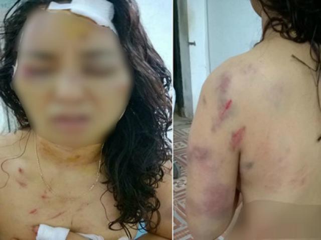 Tin tức trong ngày - Khởi tố kẻ đánh vợ cũ tổn hại 28% sức khỏe