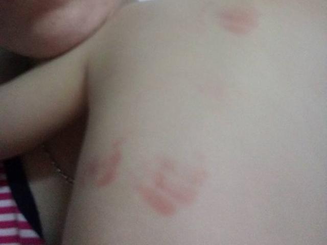 Giáo dục - du học - Hà Nội: Bé 20 tháng tuổi bị cắn tím người khi ở trường mầm non về