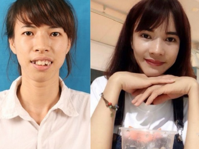 Thẩm mỹ viện - Nữ sinh Nông nghiệp răng hô "lột xác" đẹp như diễn viên