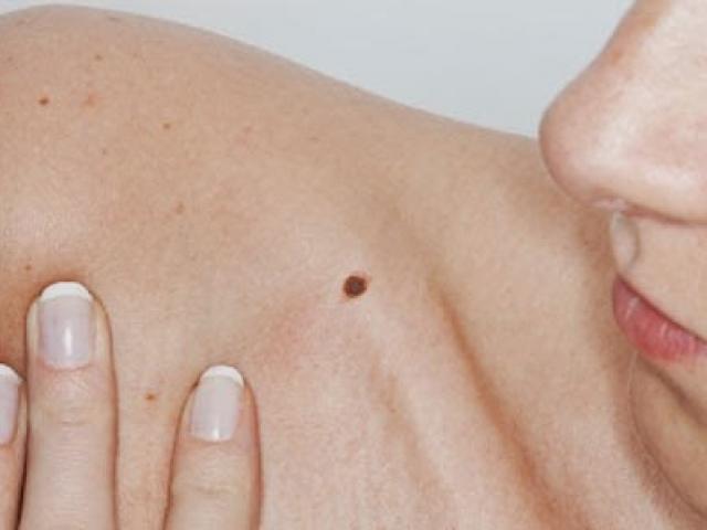 Sức khỏe đời sống - Cảnh báo mối nguy hiểm khi xuất hiện nốt ruồi trên cơ thể