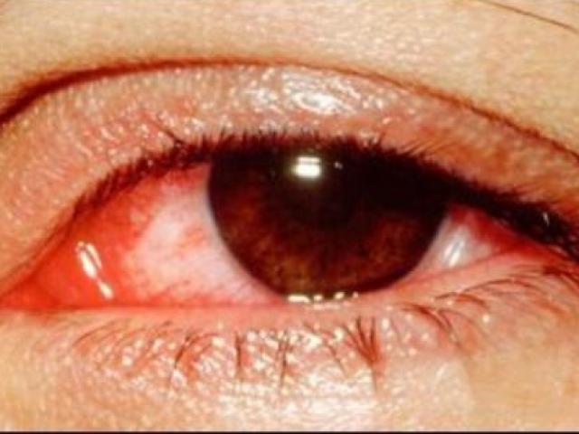 Cảnh báo dịch đau mắt đỏ vào mùa: Cách phòng và chữa bệnh