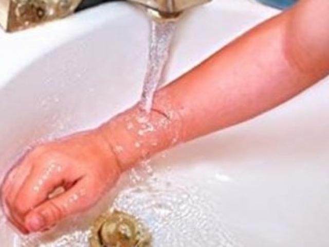 Sức khỏe đời sống - Gia tăng bệnh nhân bỏng trong dịp hè