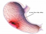 Sức khỏe đời sống - 6 dấu hiệu cảnh báo ung thư dạ dày không được bỏ qua