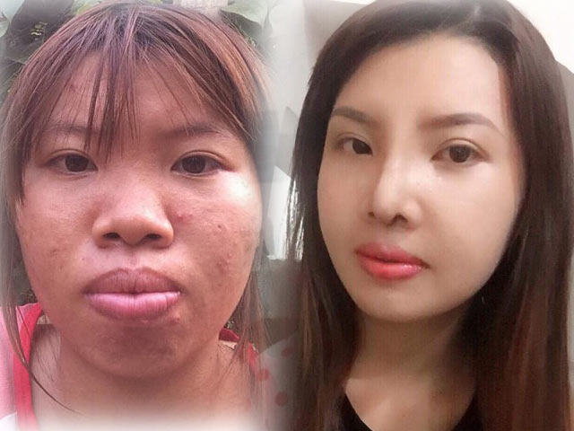 Thẩm mỹ viện - "Thị Nở tái sinh" tiết lộ ảnh sau dao kéo gây sửng sốt