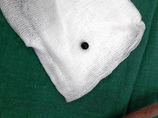 Tin tức trong ngày - Bé 8 tuổi bị đạn găm vào đùi khi hàng xóm bắn chim