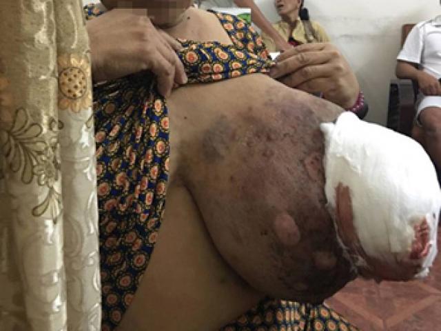 Sức khỏe đời sống - Lạnh sống lưng nghe bệnh nhân kể chữa ung thư bằng chọc gai bưởi