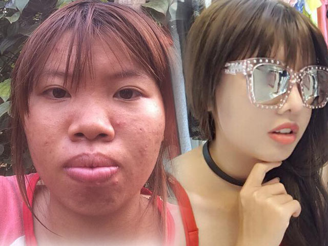 Thẩm mỹ viện - "Thị Nở tái sinh" đẹp như gái Hàn sau dao kéo trăm triệu
