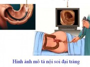 Sức khỏe đời sống - Loại ung thư khiến nhiều người nhầm bệnh... trĩ