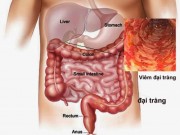 Sức khỏe đời sống - Nếu không muốn ung thư đại trực tràng, hãy ngừng ăn triền miên các món này