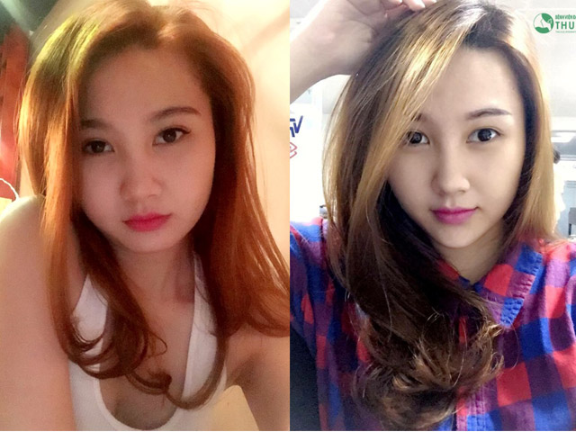 Bí quyết làm đẹp - Làm đẹp không xâm lấn – đơn giản nhưng đừng chủ quan